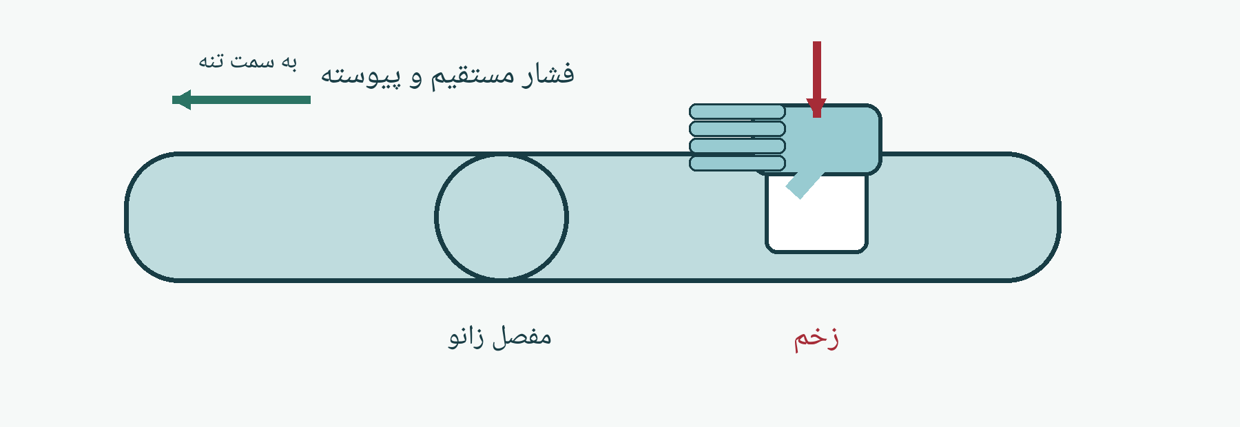 طرح آموزشی خونریزی شدید را با فشار مهار کنید