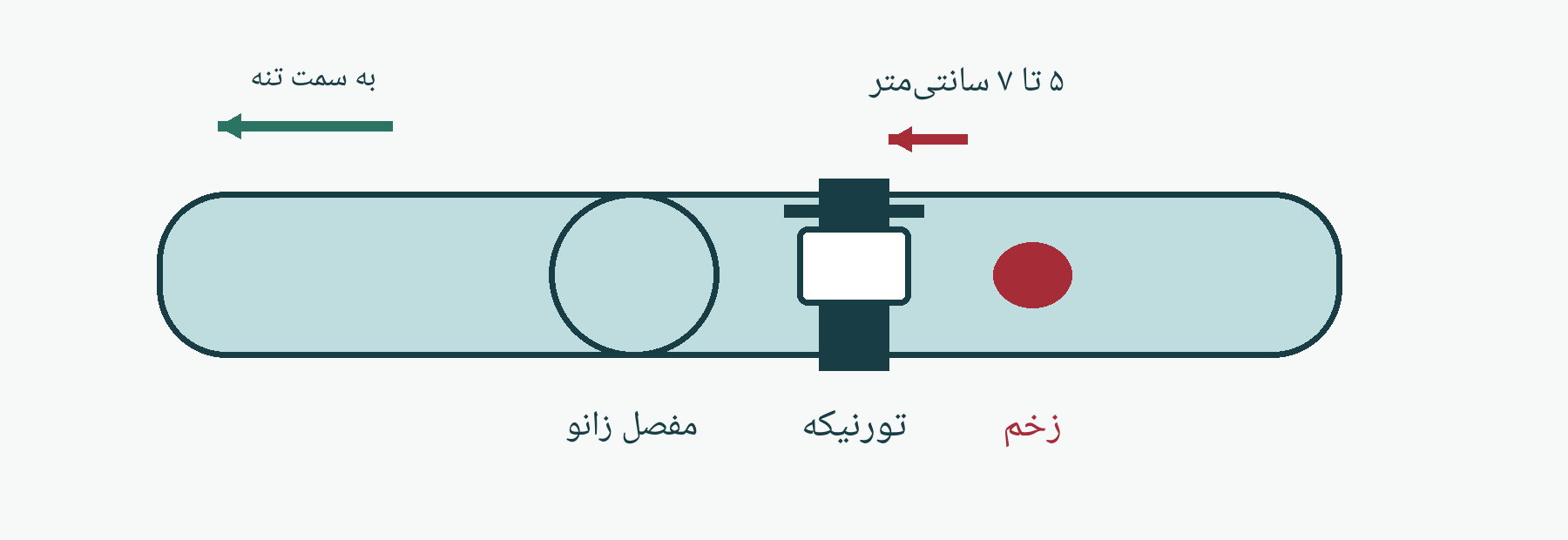 طرح آموزشی تورنیکه برای خونریزی مرگبار دست یا پا